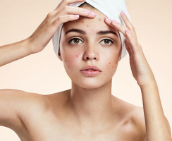 Những lưu ý khi chăm sóc da đang bị mụn và sau khi hết mụn